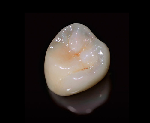 PFM | Dental Lab New York