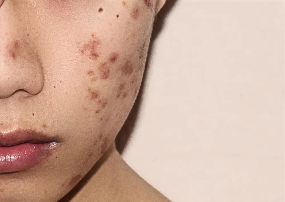 Scientists Find Teenage Acne May be a Natural, Transient Inflammatory State