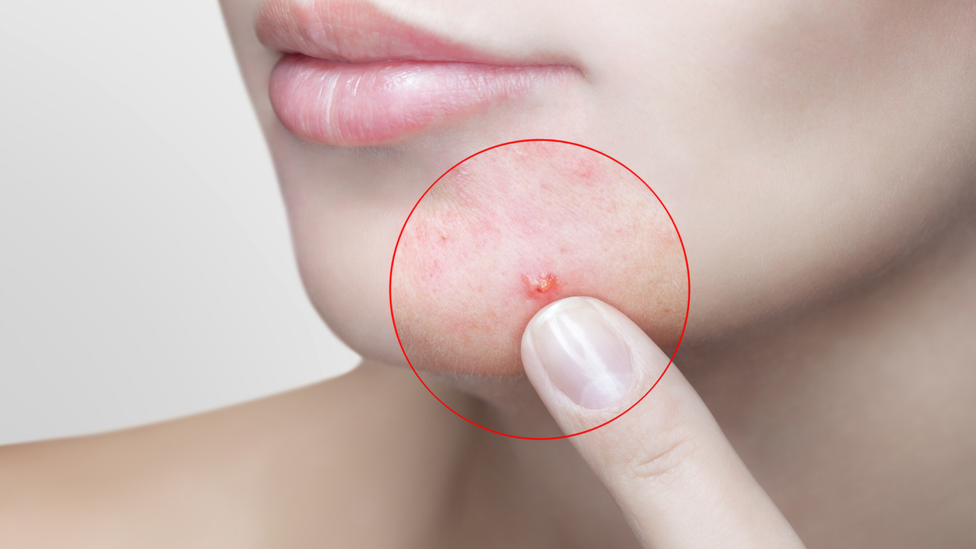 Acne and the Correlation Between Comedogenic Ingredients in Skincare Products
