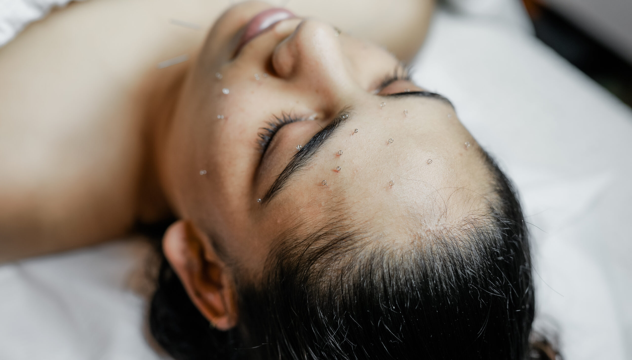 The Benefits of Acupuncture