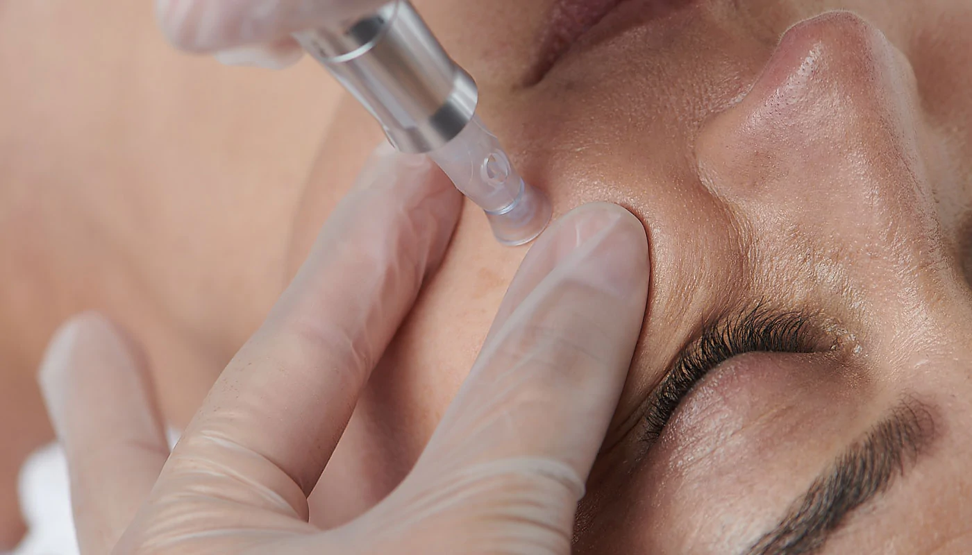 What is the Difference Between Mesotherapy and Microneedling?