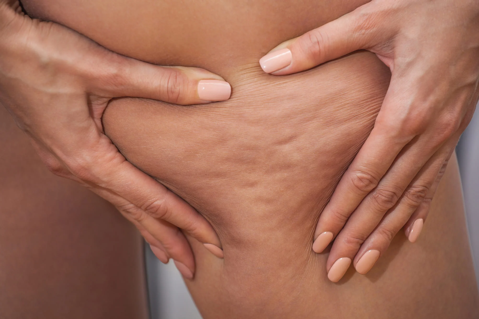 Let's Get Realistic About Cellulite