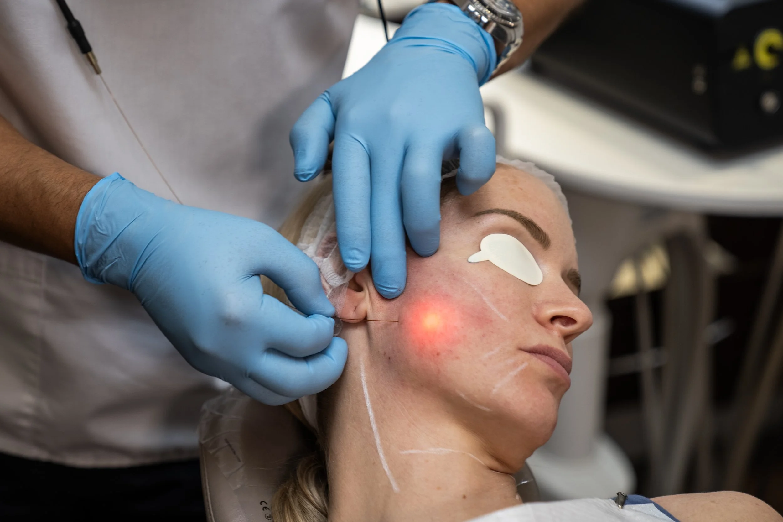 ENDOLIFTx and Lutronic Combine Forces to Create New BabyLift Treatment