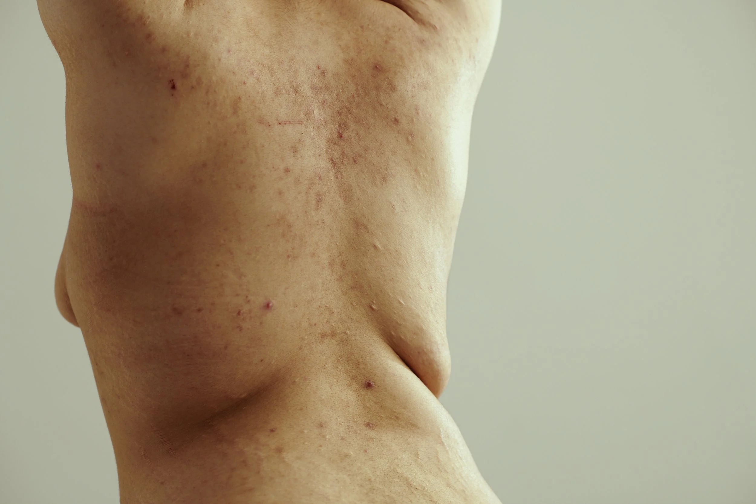 Sudocrem Unveils Bold New Campaign, Uncovered, to Celebrate Skin in All its Forms