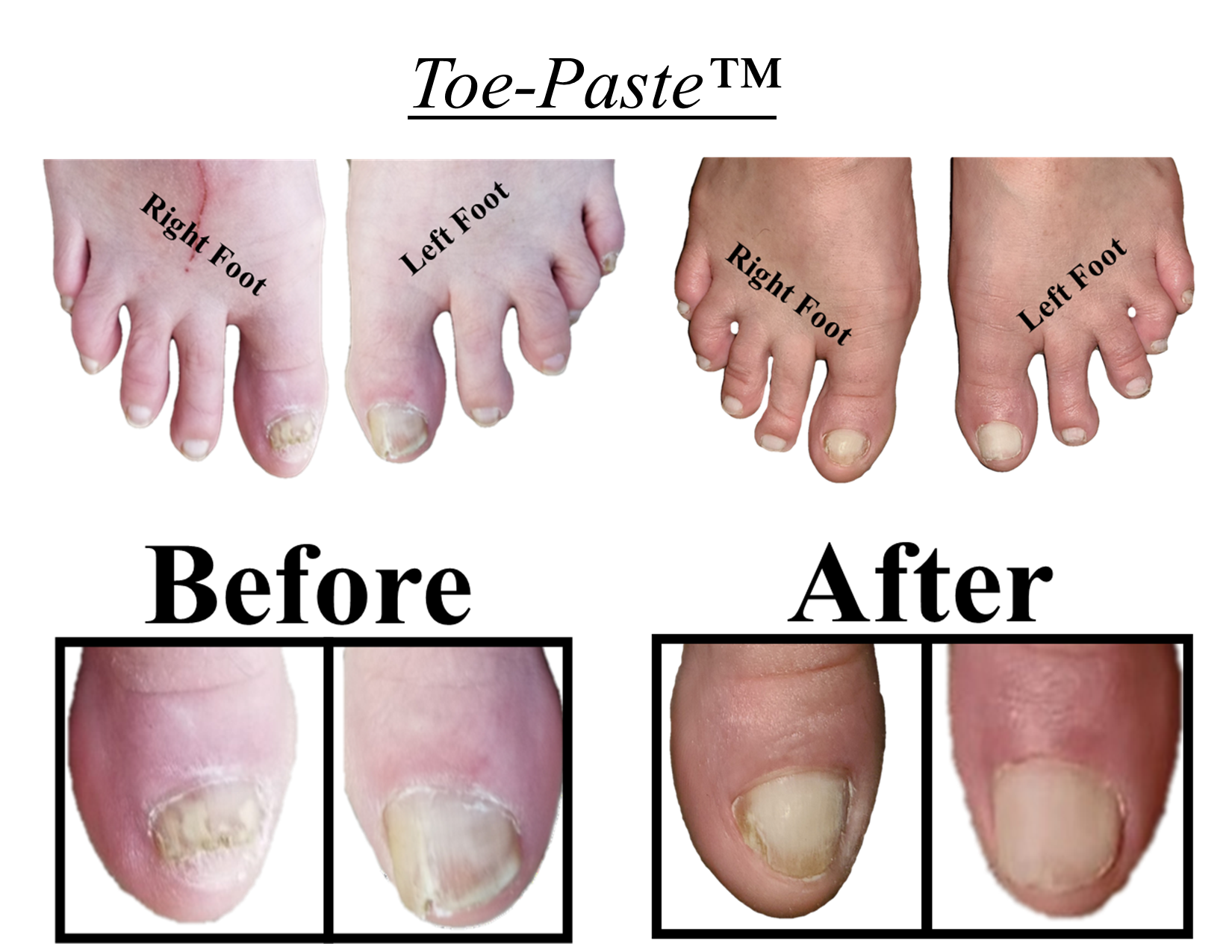 Recognising And Treating Onychomycosis (Fungal Nail)