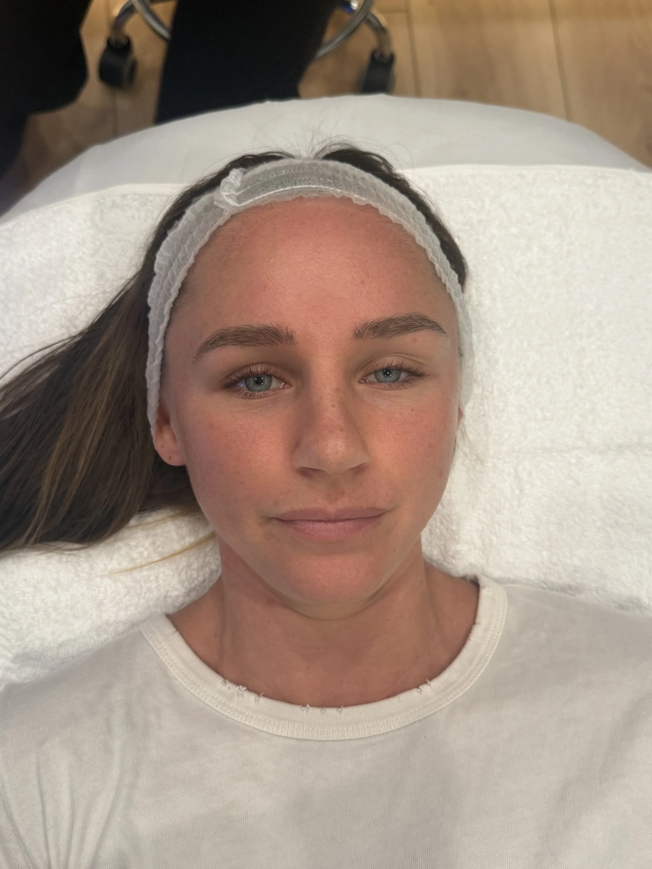 Before HydraFacial