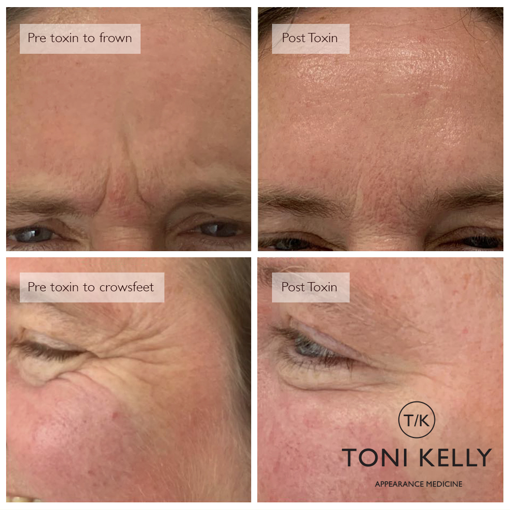 Frown/Crowfeet Botox before and after