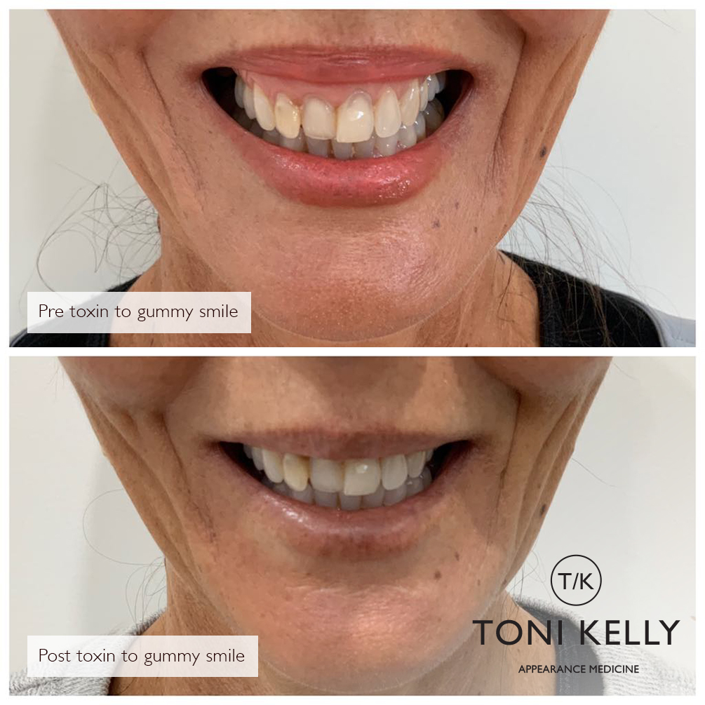Gummy smile before and after botox