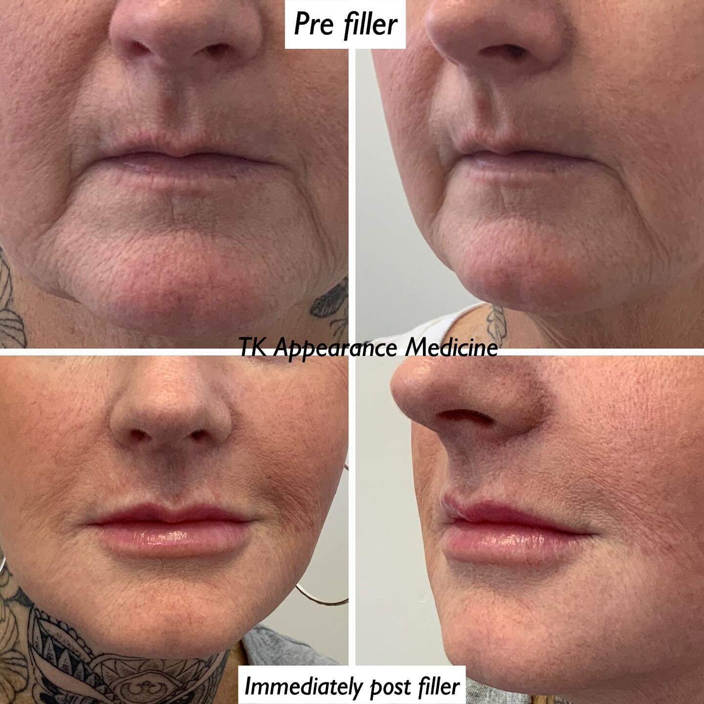 The tiniest of tweaks needed now for this 51 year old lady&hellip;. She gets more gorgeous every time I see her!  #regulartreatments #onceortwiceayear #tkappearancemedicinehamilton