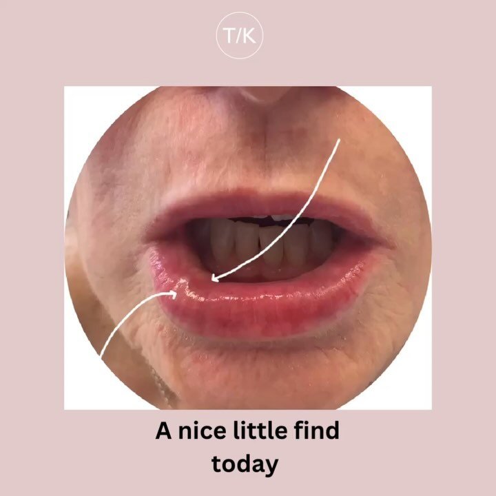 A beautiful bit of lip anatomy  that you dont often see jump out at you when injecting&hellip;.but a crucial bit all the same.  The inferior labial artery, something you definitely want to avoid! And phew, swipe to see the finished result&hellip;..ar