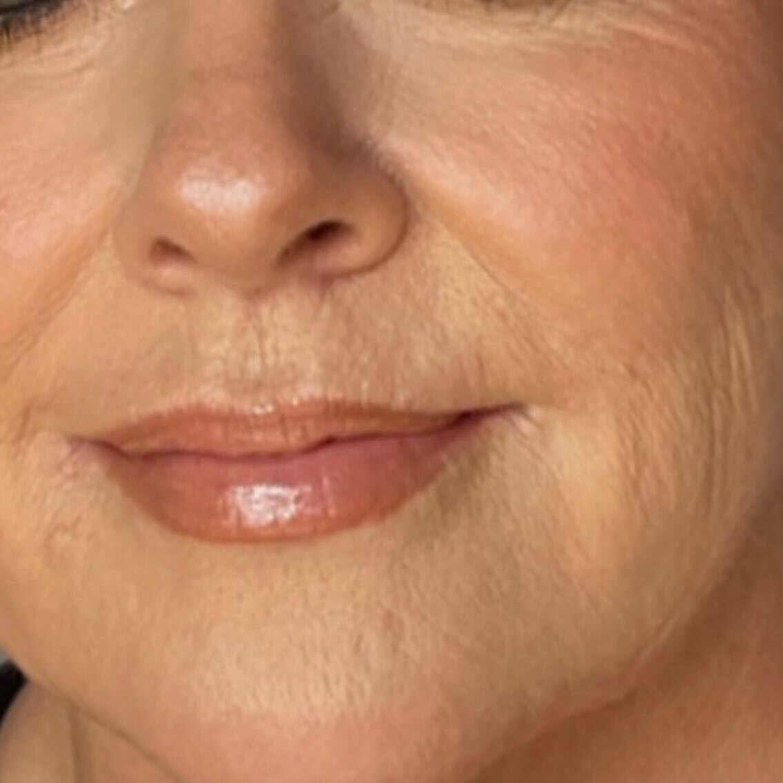 How gorgeous are the post treatment results for this stunning 60yr old lady.  Professional makeup applied, no filters. I have treated her mouth area 3 x now and the results just keep getting better&hellip;.now it&rsquo;s all about maintenance. 
#fill