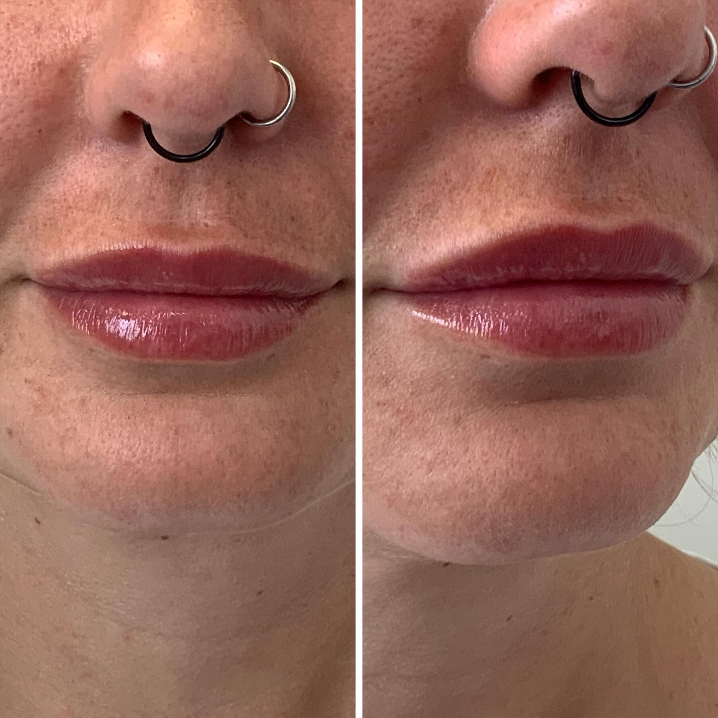 Second treatment for these lips today&hellip;.0.4mls added. 
Hydrated, full, lush, not overdone and totally within keeping of her facial features . Toni xx