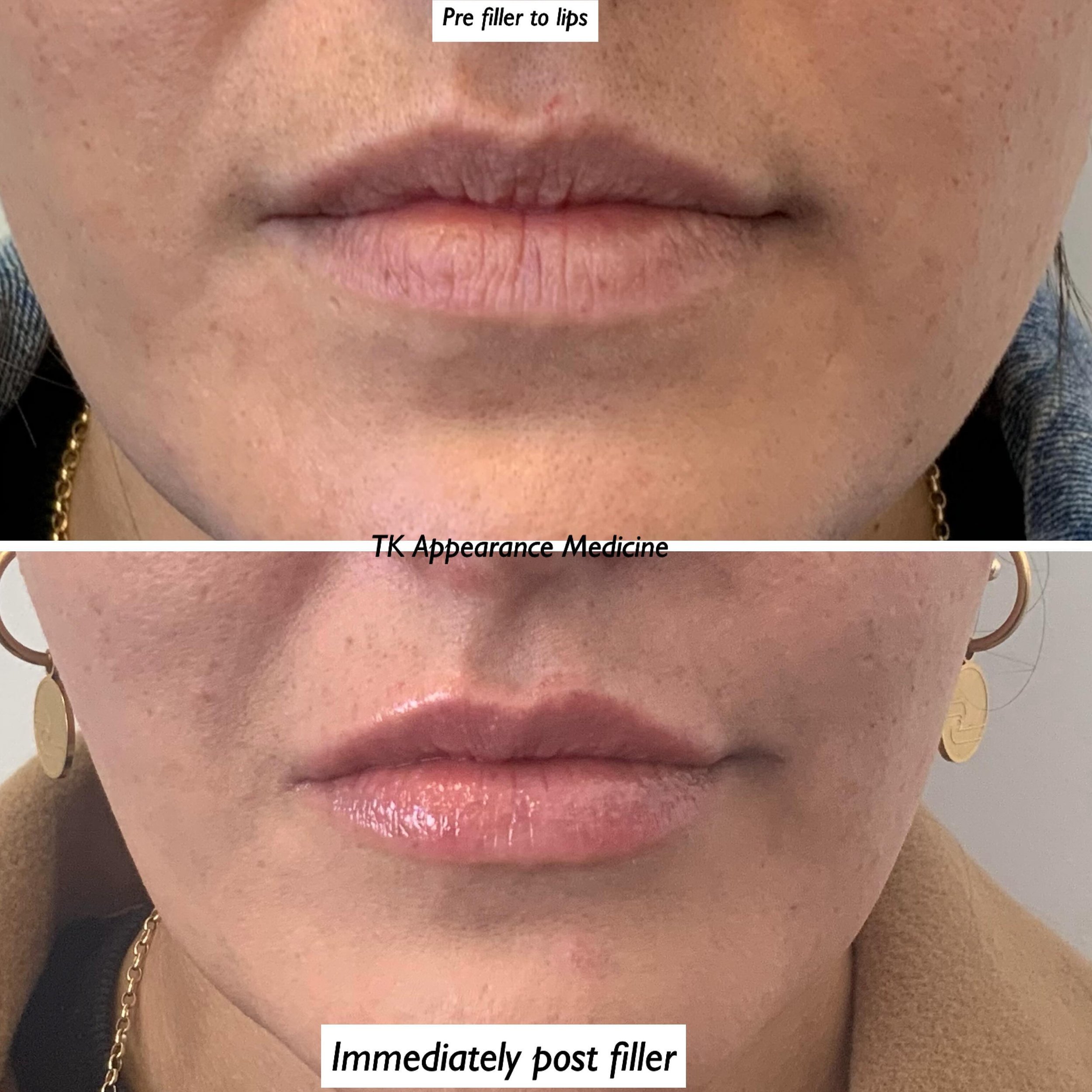 A total of 0.5mls  of premium lip  filler injected into these lips.  A lovely natural augmentation 

Toni xx