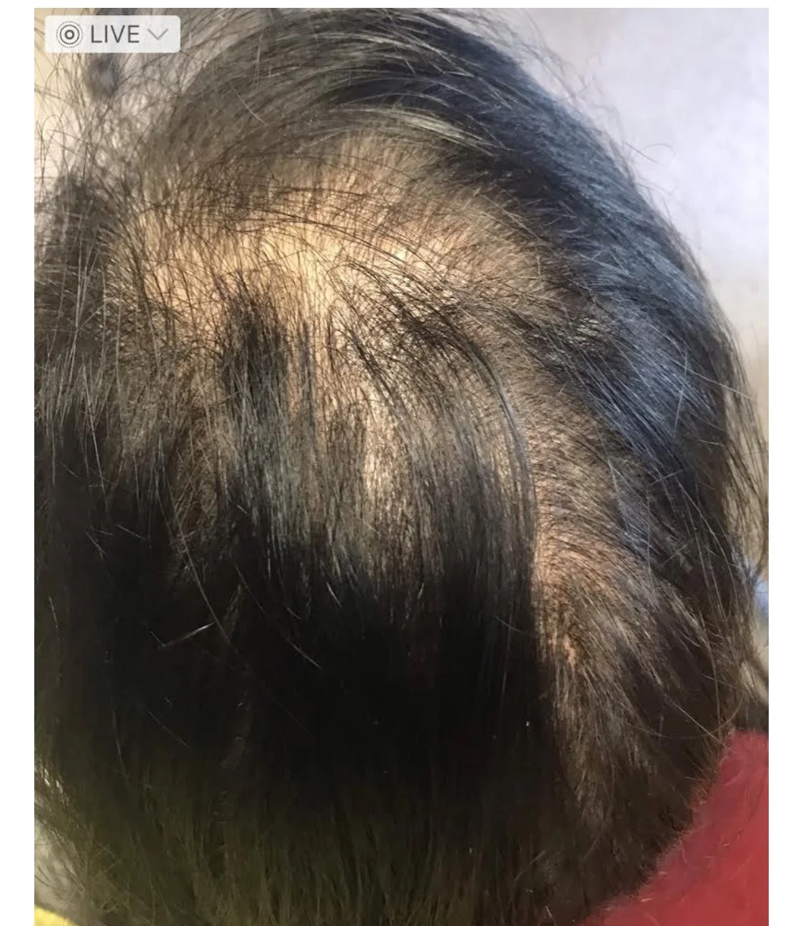 Before PRP Hair  (2).jpeg
