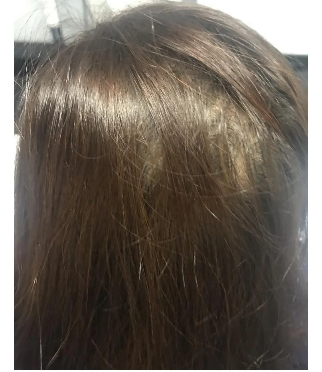 After 3 PRP Hair  (2).jpeg