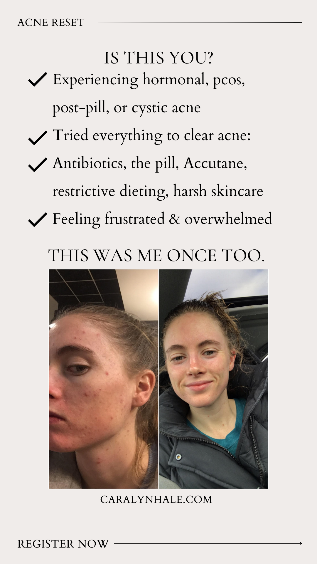 The Pill & Acne, Coming off the Pill without breaking out — Caralyn