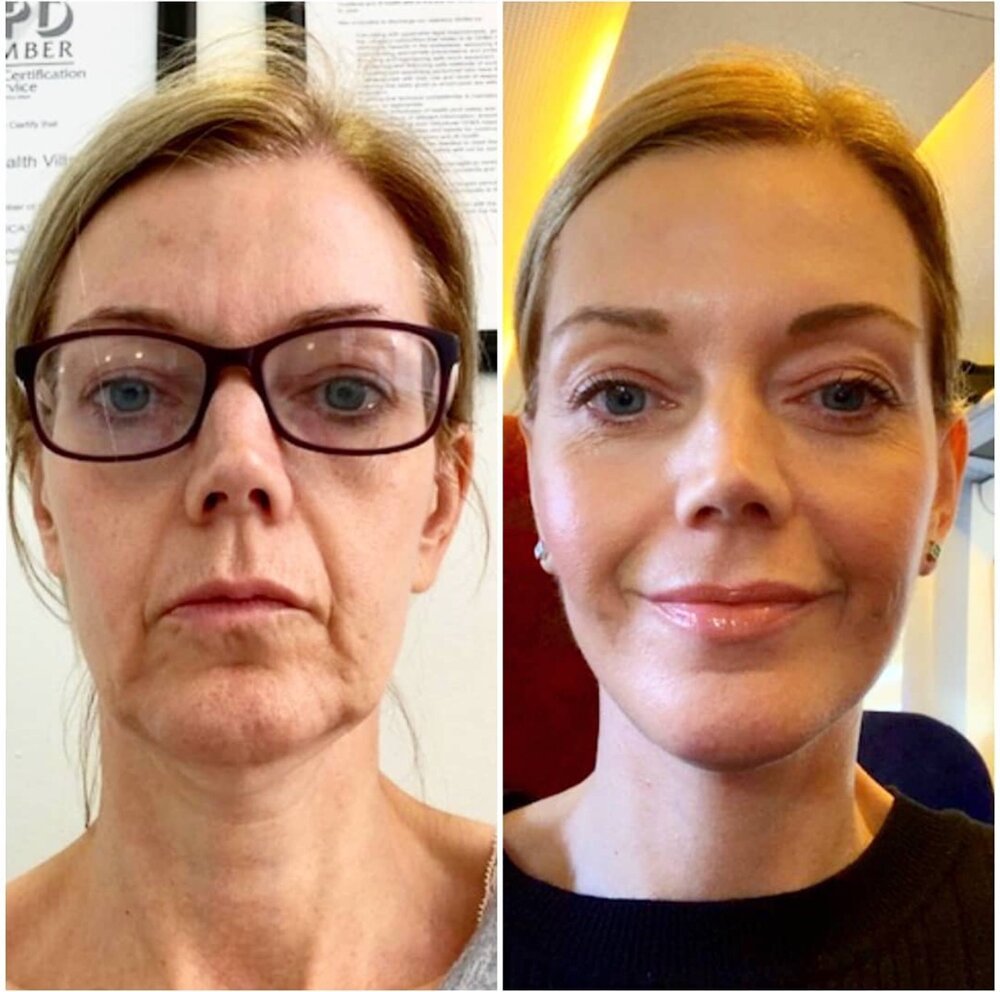 TBT Facelift Surgery Dubai Abu Dhabi Mini Face lift