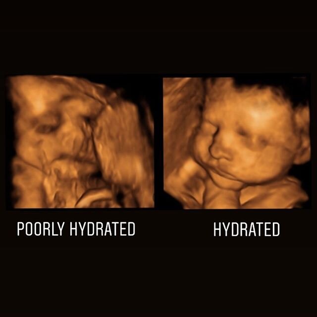 Get hydrated mommas!! 💧
..
Hydration is a big factor when getting ultrasounds. We do not ask that you have a full bladder during your visit, but drinking plenty of water prior to it is important! At least days before, if not weeks, you should be dri