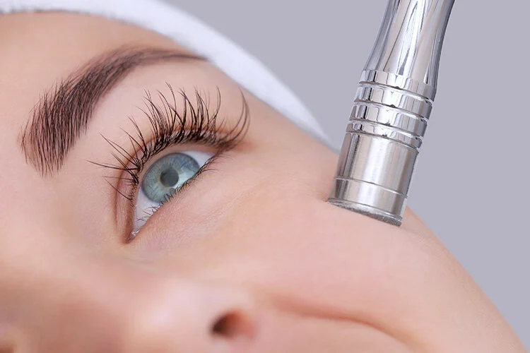 Microdermabrasion