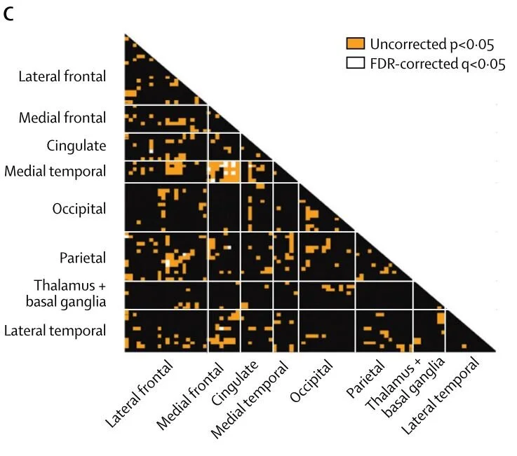 Functional connectivity of large-scale brain networks in patients with anti-NMDA receptor encephalitis: an observational study