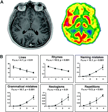 Primary Progressive Aphasia: Quantitative Analysis