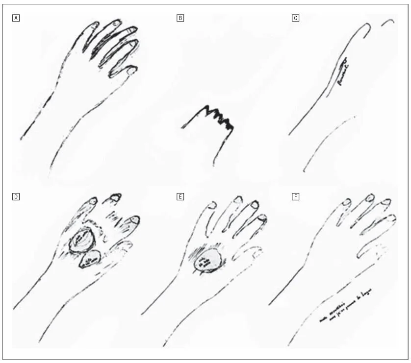 Neural Mechanisms of Embodiment Asomatognosia Due to Premotor Cortex Damage