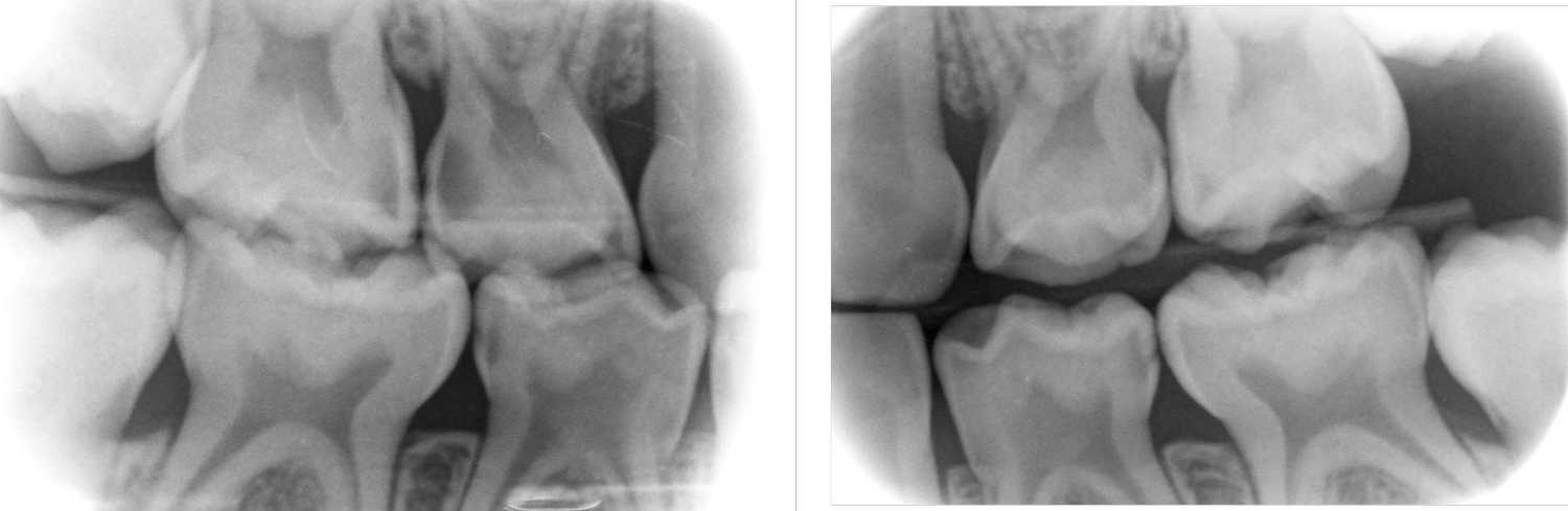 Part 1: Evidence for Radiographic Examinations in Paediatric Dentistry ...
