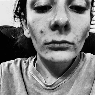 Original_Maria-Conti_Spironolactone-Adult-Acne_2.jpeg