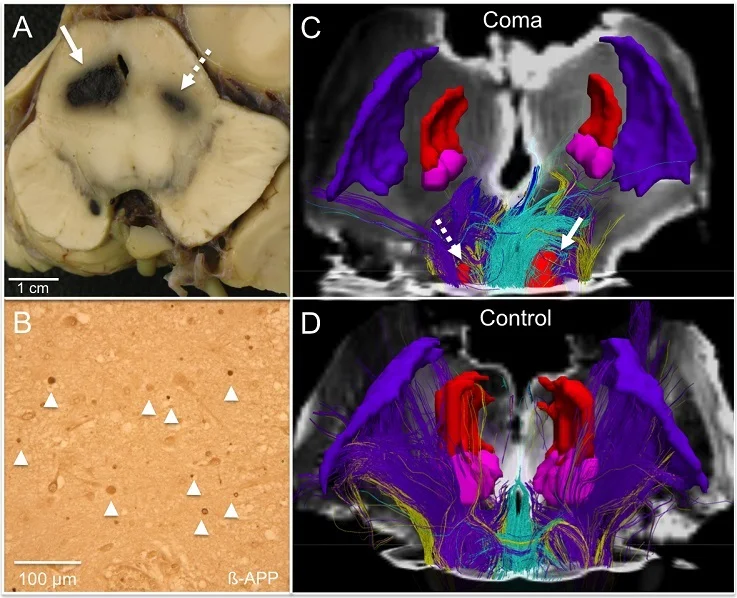 Ex Vivo Connectomics of Traumatic Coma