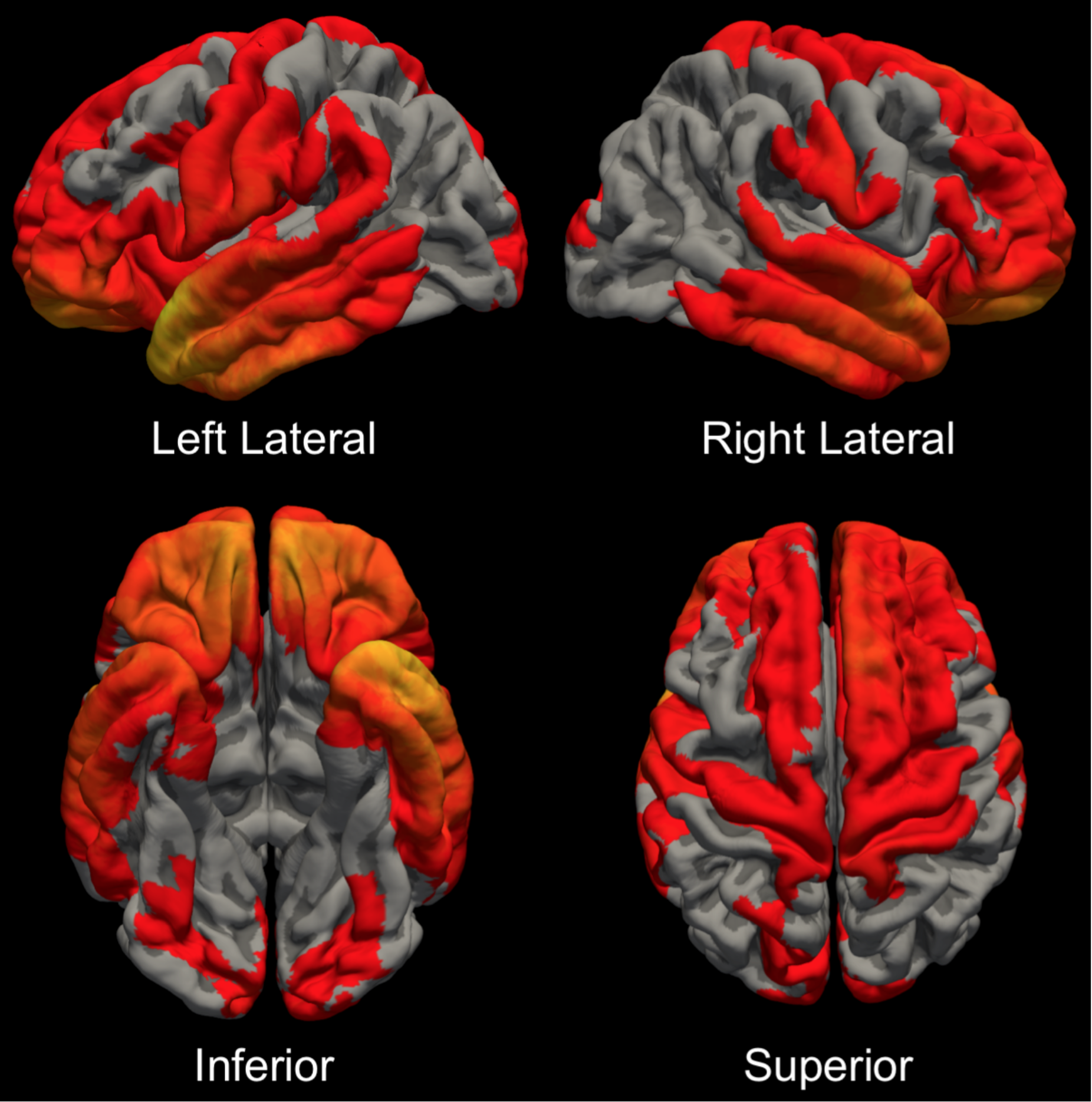 Late Effects of TBI