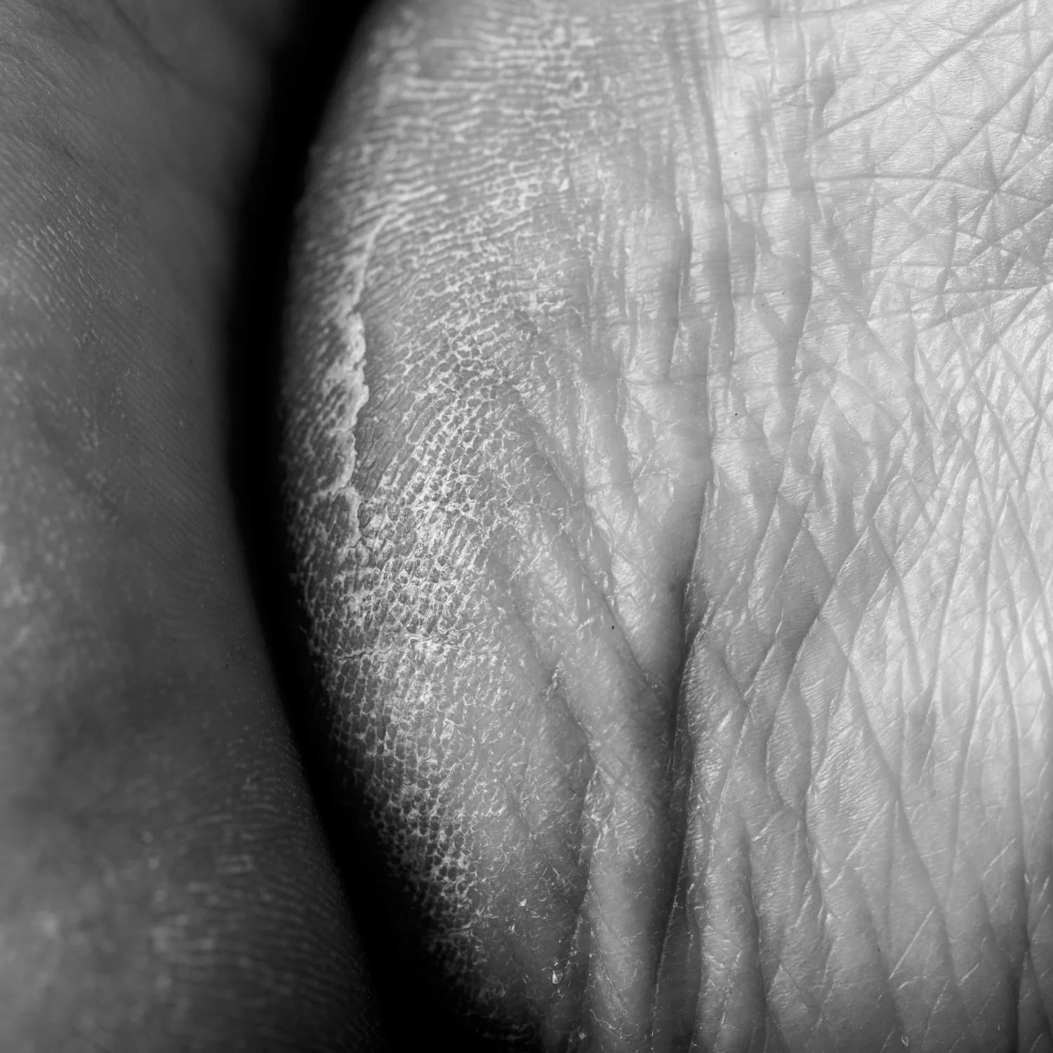 Achilles Heel