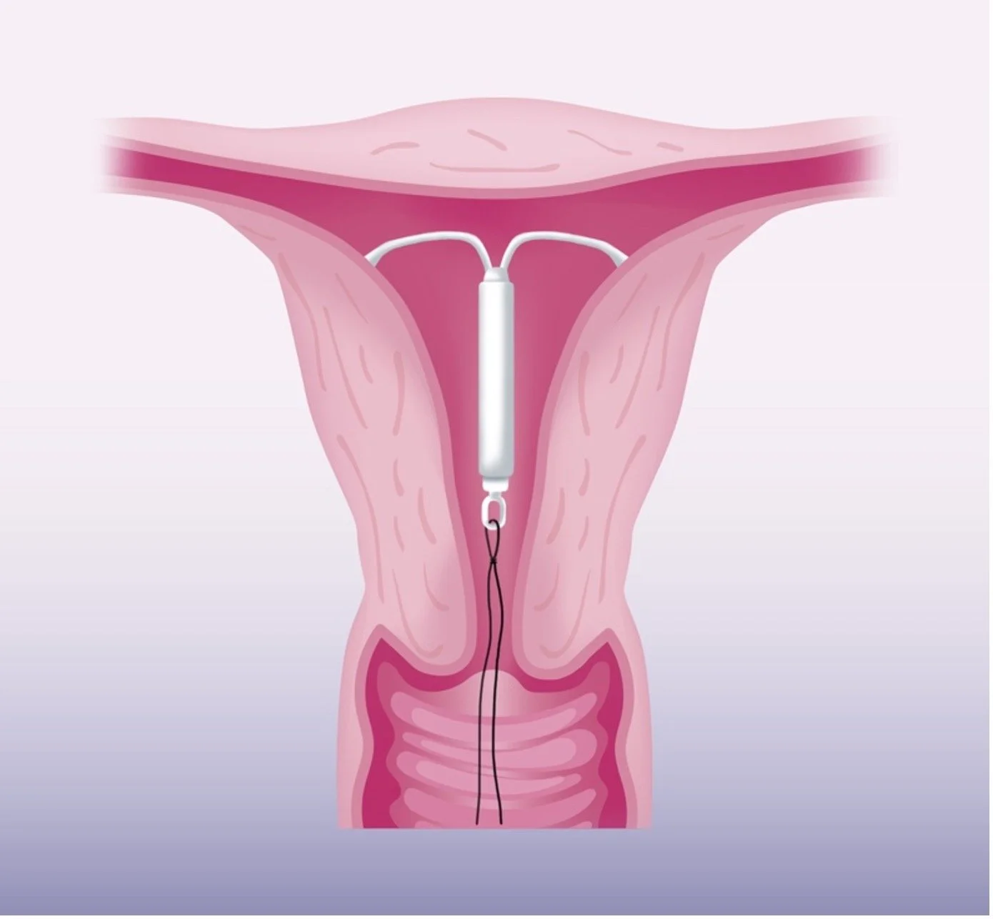 Hormonal IUD - Mirena pro's and con's