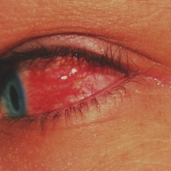 red%2Beye%2Bconjunctiva.jpg