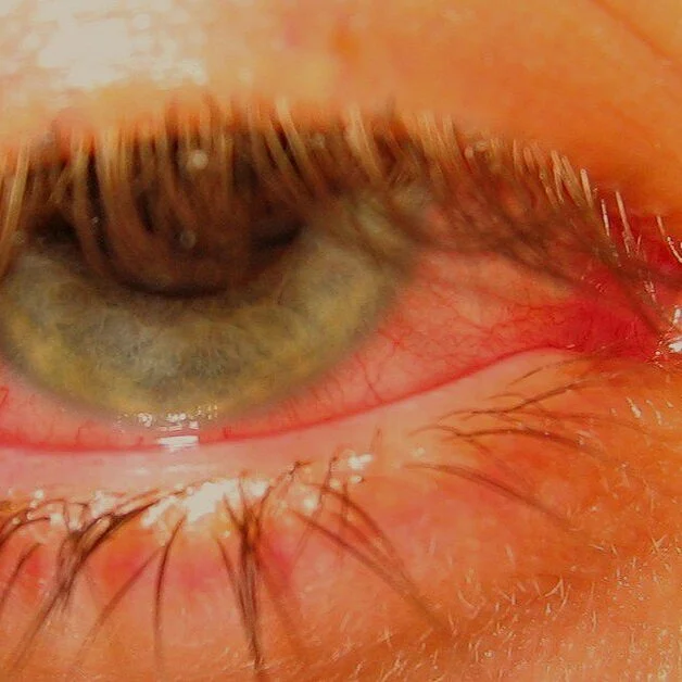 red+eye+infection.jpg