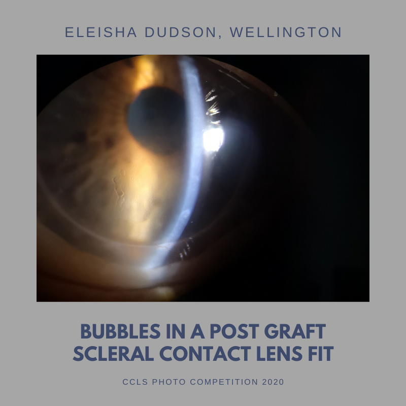 CCLS - Bubbles in a post graft CL fitting.png