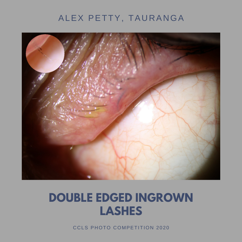 CCLS - Double Edged Ingrown-2.png