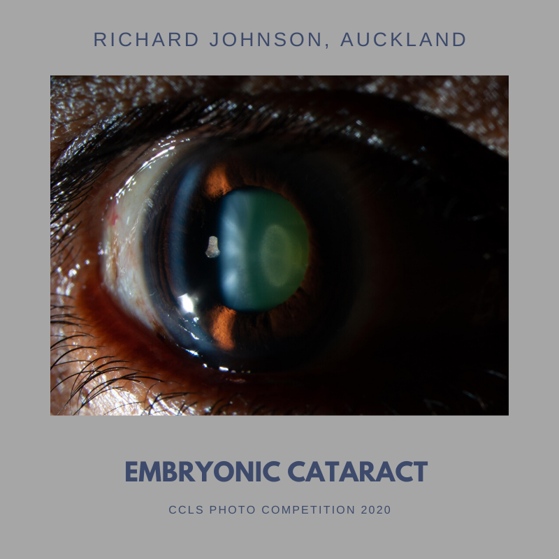 CCLS - embryonic cataract-2.png