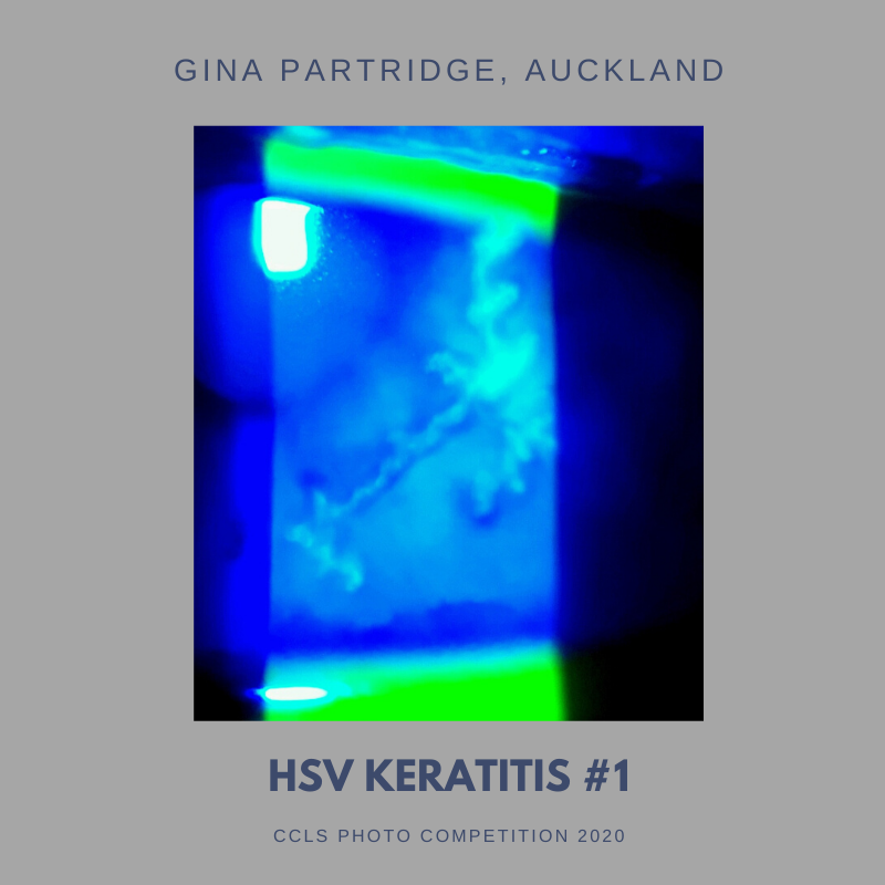 CCLS - HSV Keratitis #1-2.png