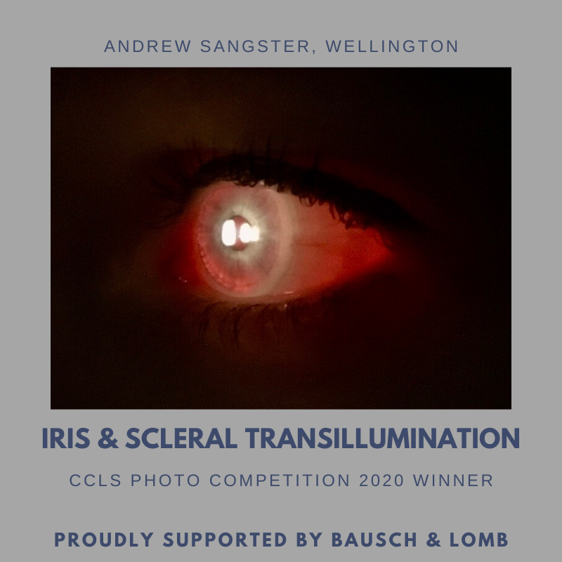 CCLS - IRIS _ SCLERAL TRANSILLUMINATION-3.png