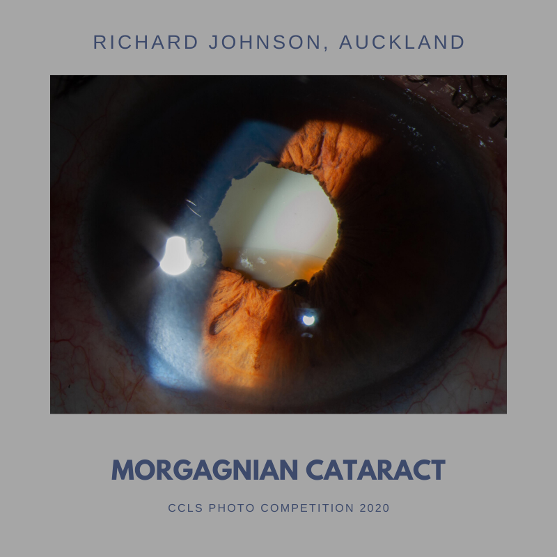 CCLS - Morgagnian Cataract-2.png