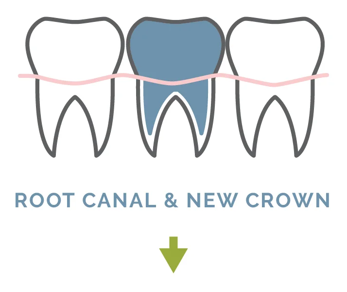root_canal-01.jpg