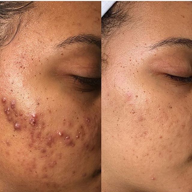 Our Acne Facial is one of our most common rendered services. Clear results are achieved with consistent treatment. Schedule with one of our skincare therapists today.