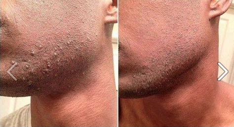 Pseudofolliculitis Barbae Treatment Lancaster PA | Razor Bump Relief ...