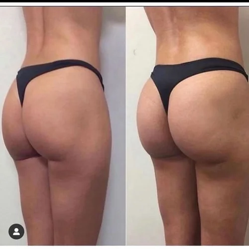 Does Vacuum Butt Lift Work: Truths You Need to Know Now