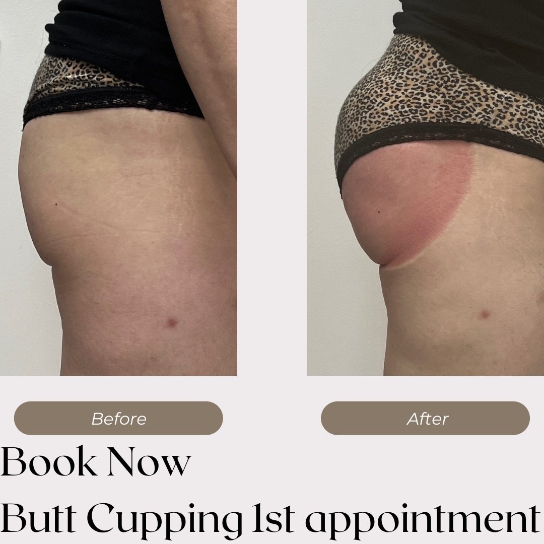 Butt Cupping Vacuum Treatment — Lancaster's Luxe Lashes