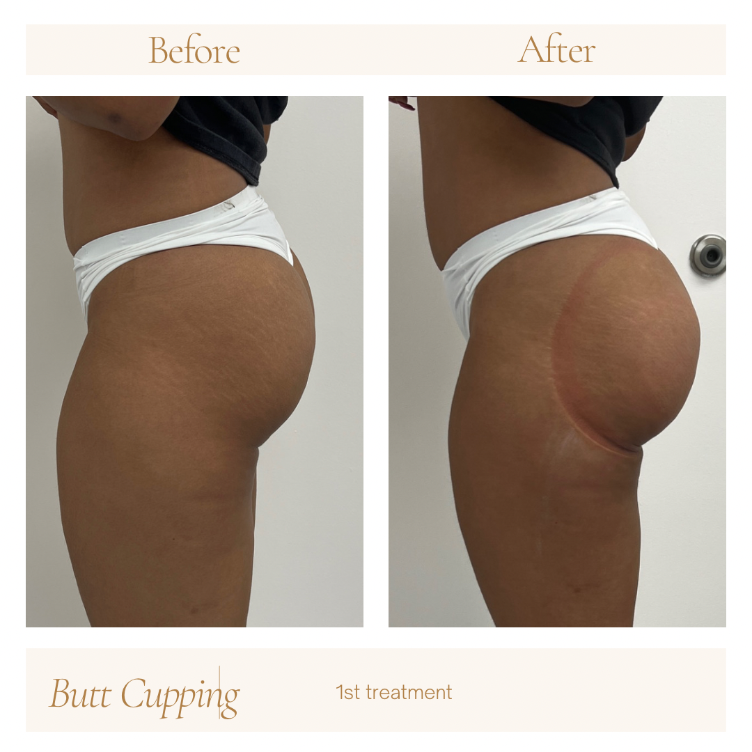 Butt Cupping Vacuum Treatment — Lancaster's Luxe Lashes