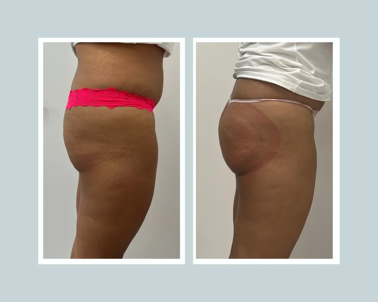 How Long Does Vacuum Therapy Buttocks Last: Ultimate Duration Guide