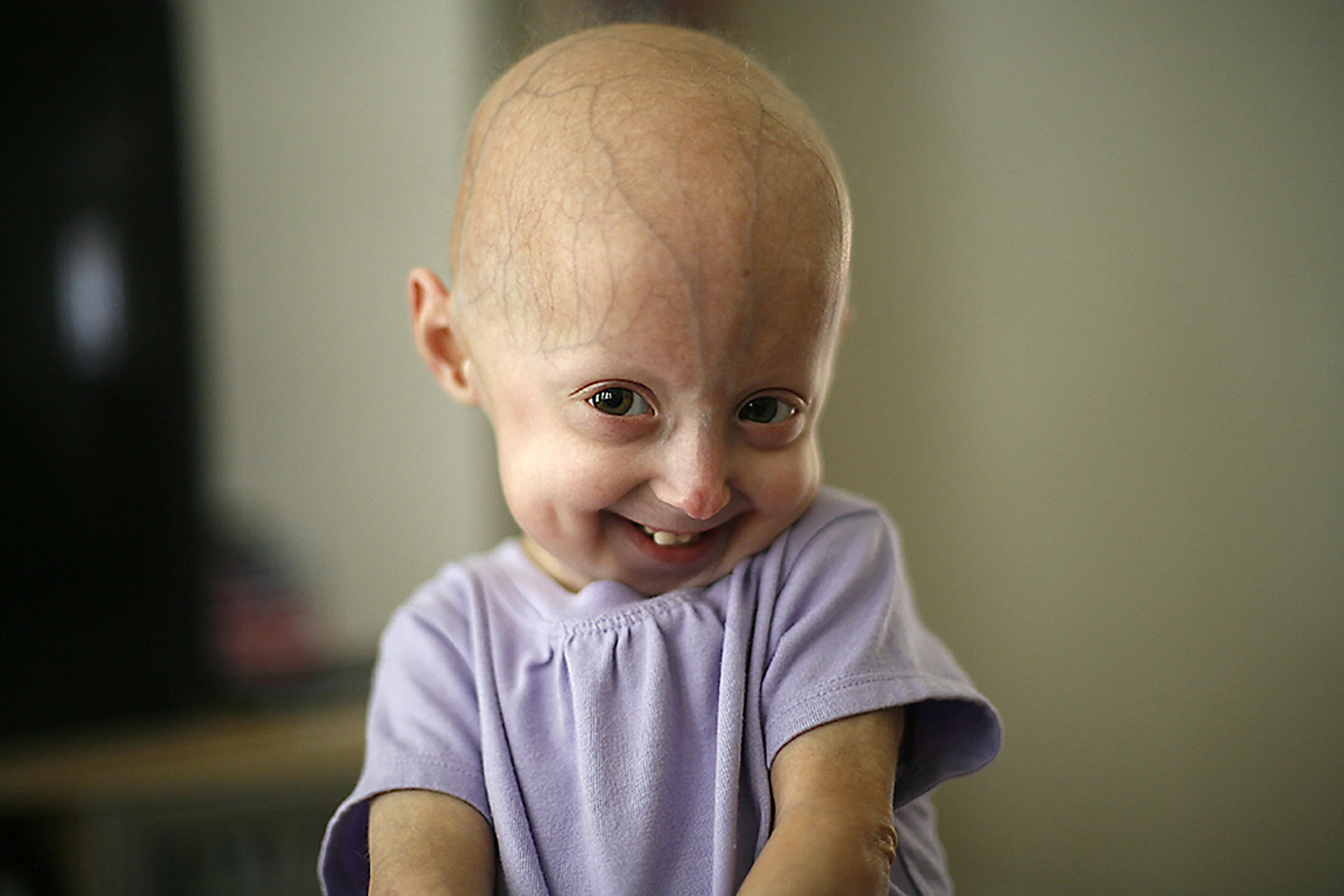  FOR TWIST0803_lindsayLindsay Ratcliffe CQkpm, 4, of Flat Rock, was diagnosed with Progeria when she was 5 five months old. Prgoeria is a disease that ages children 8 times faster than normal giving them a short life expectancy. Ratcliffe was photogr
