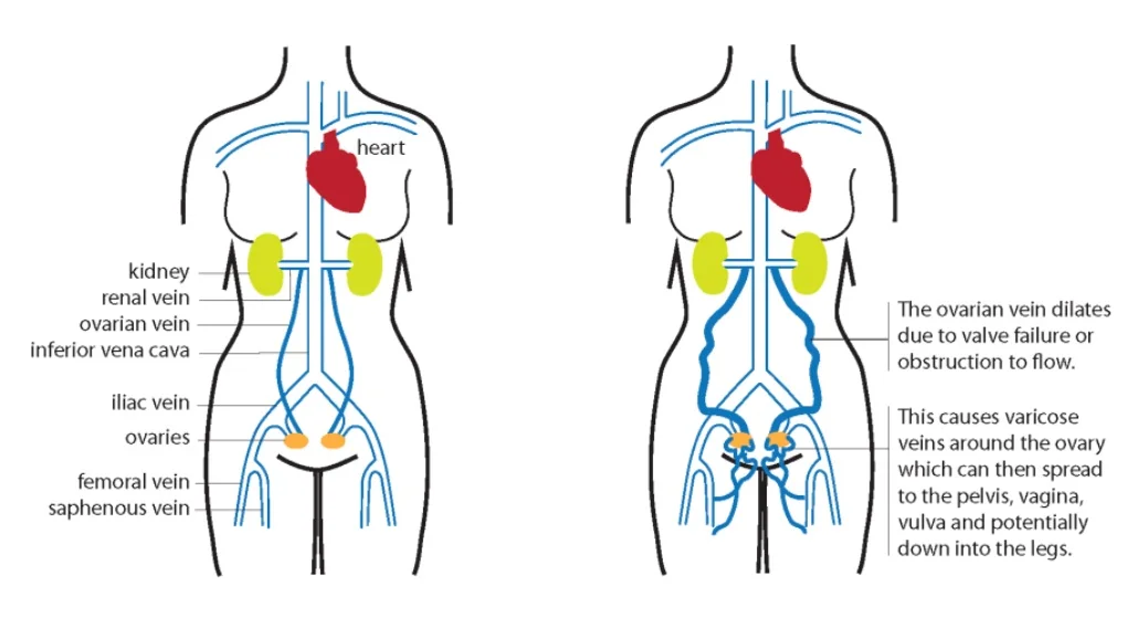 Pelvic Venous Congestion Syndrome Just Veins Clinic