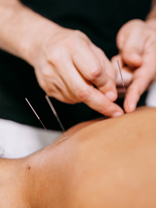 acupuncture-sessiont.jpg